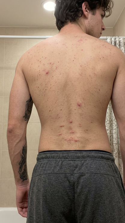 Man's bare back showing acne breakouts before using Bacne Out Bar