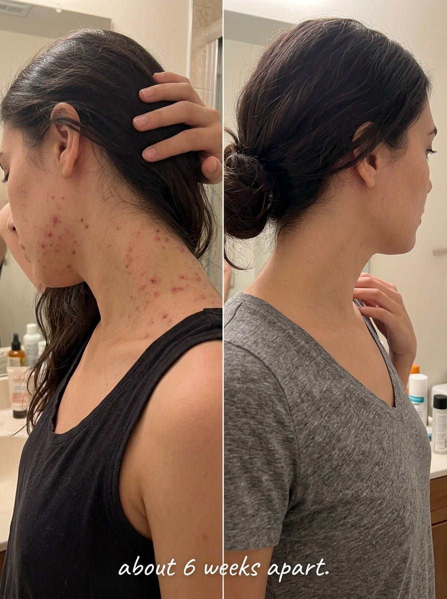 Before and after neck and jaw acne clearing about 6 weeks apart